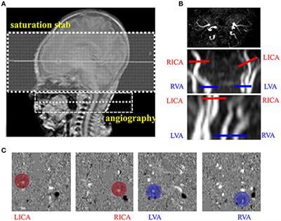 Hemodynamic and Metabolic Assessment of Neonates With Punctate White Matter Lesions Using Phase-Contrast MRI and T2-Relaxation-Under-Spin-Tagging (TRUST) MRI